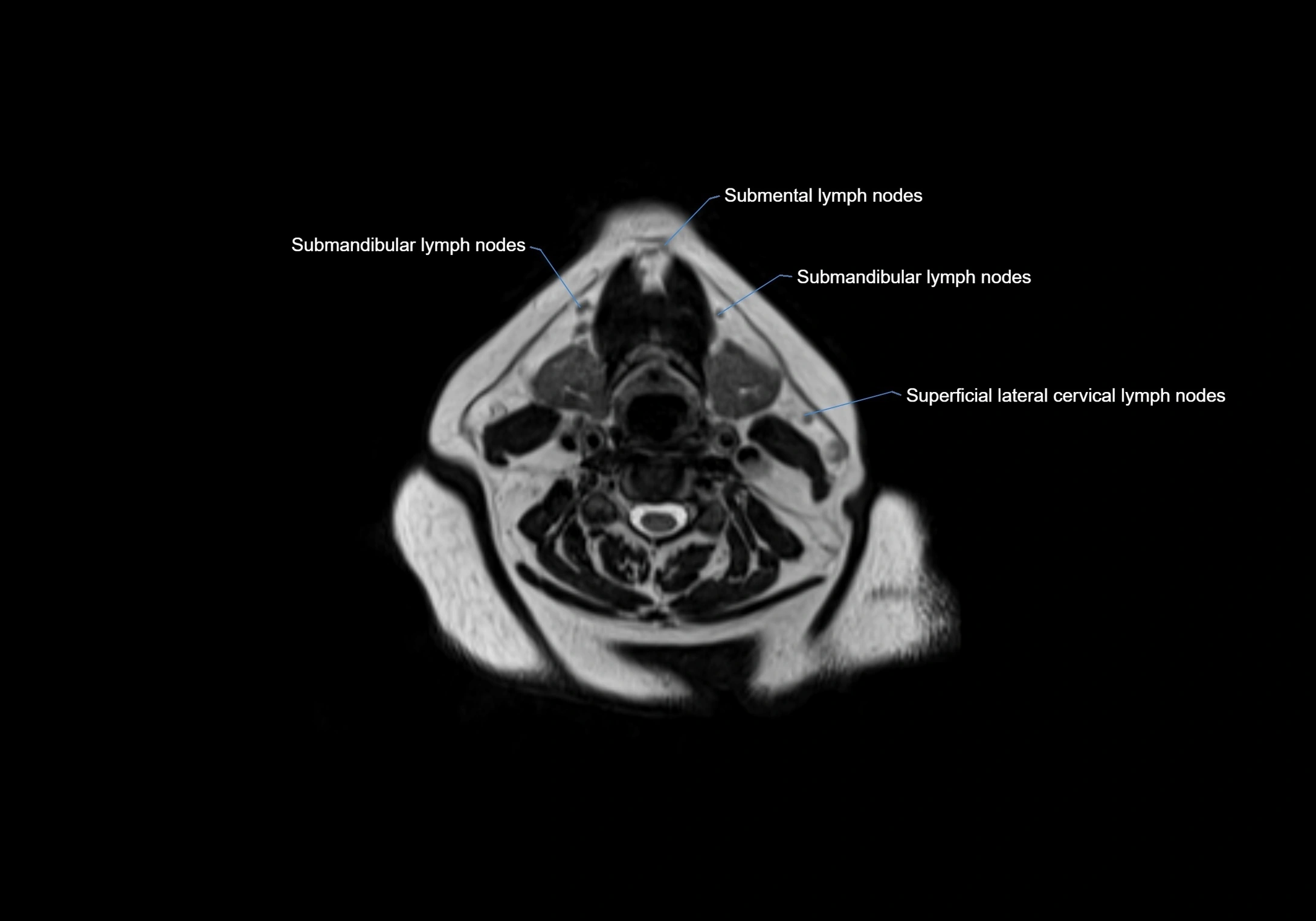 Neck axial  lymph node cross sectional MRI anatomy 3T MRI  image-img-00001-00056.webp